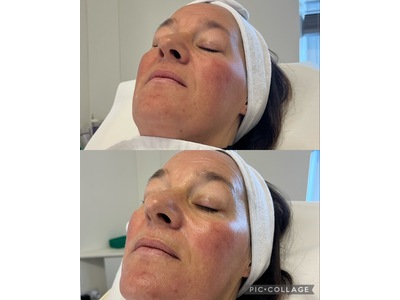 classic facial