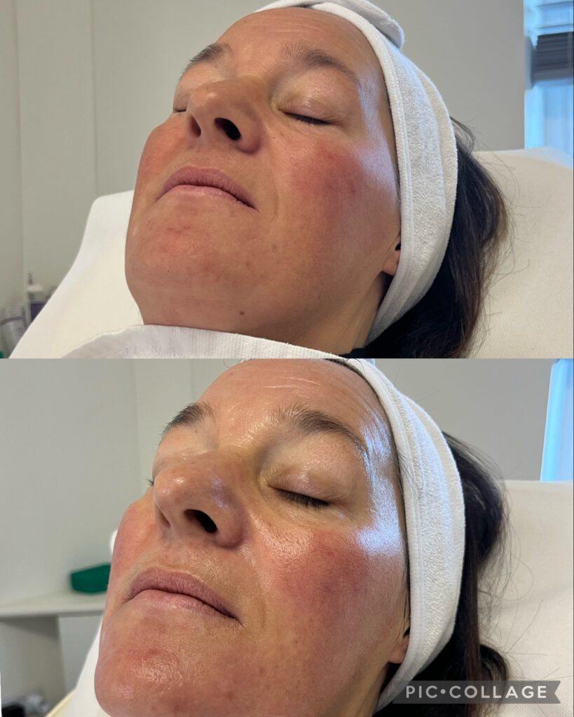 classic facial