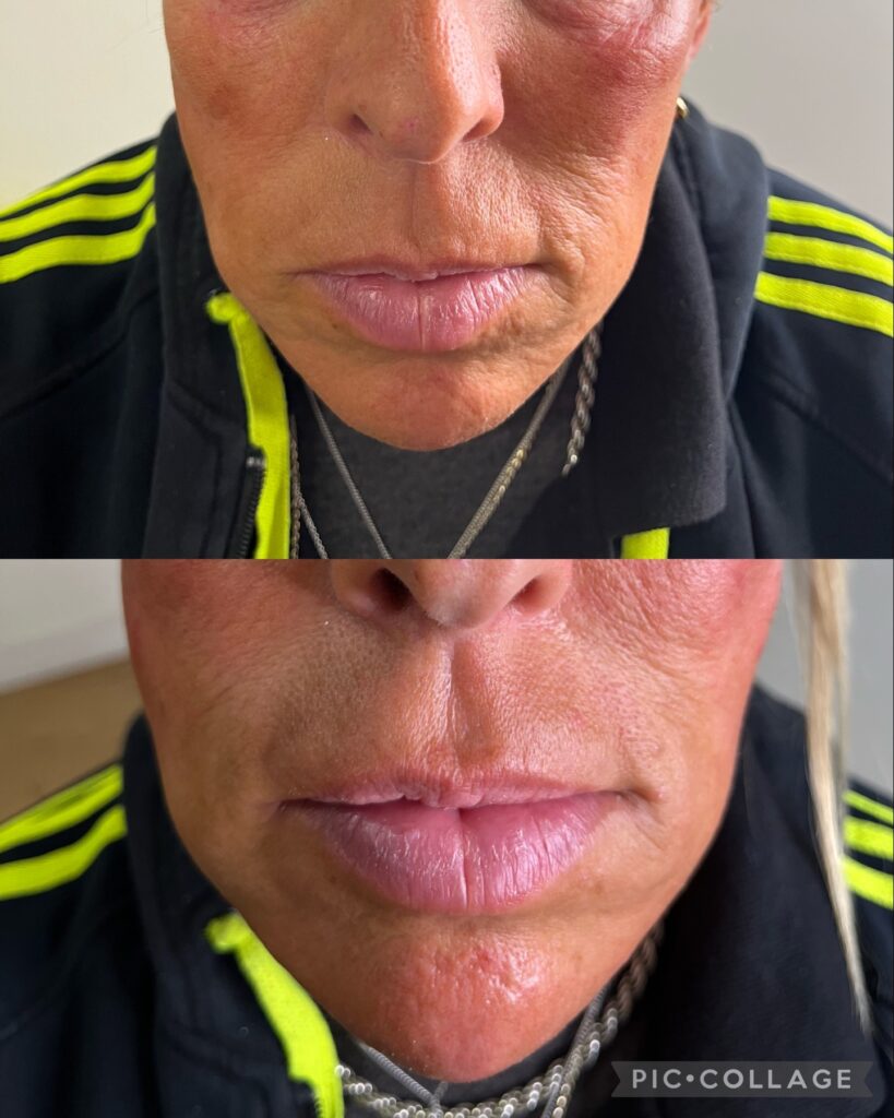 dermal filler (chin)