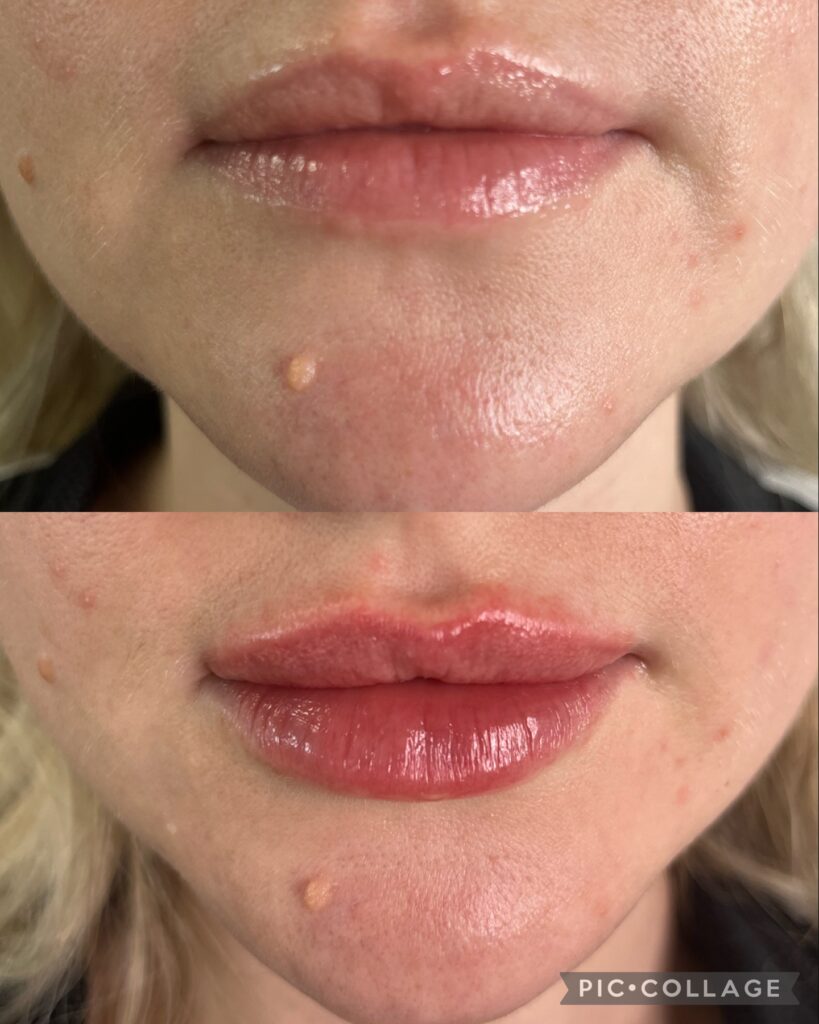 dermal filler lips