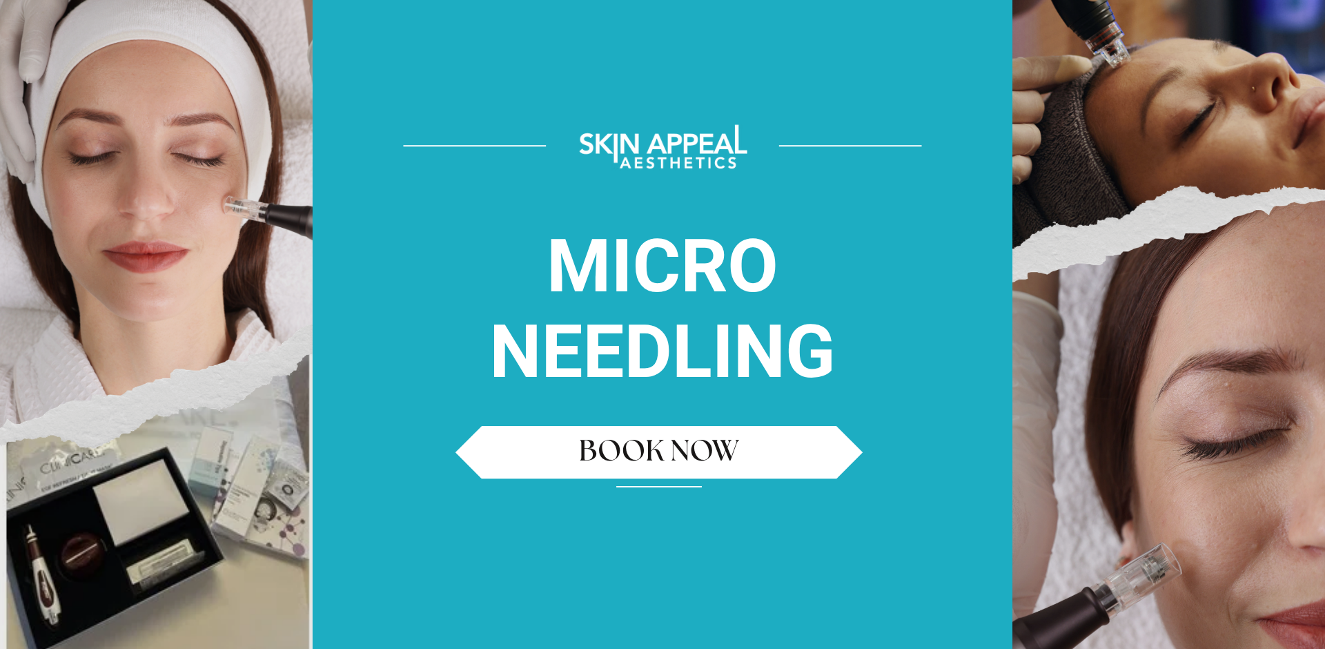 micro needling